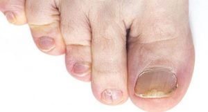 A Brief Guide on How to Get Rid Of Yellow Toenails. Effective Remedies of Getting Rid Of Yellow Toenails Without Medication: